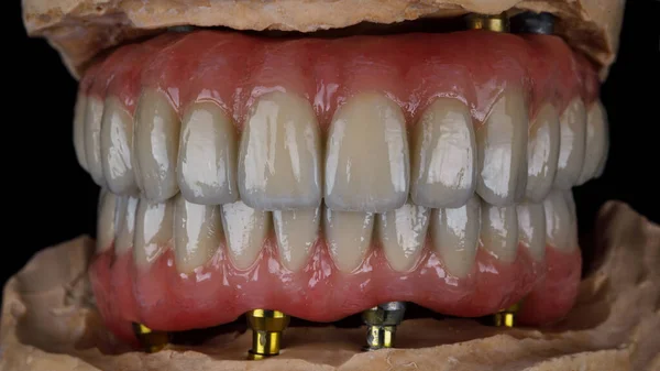 Próteses Dentárias Das Mandíbulas Superior Inferior Feitas Titânio Cerâmica Mordida — Fotografia de Stock