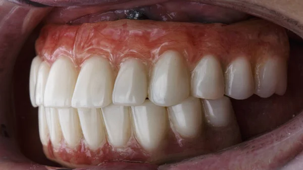 Próteses Dentárias Temporárias Para Toda Mandíbula Boca Doente Após Implantação — Fotografia de Stock