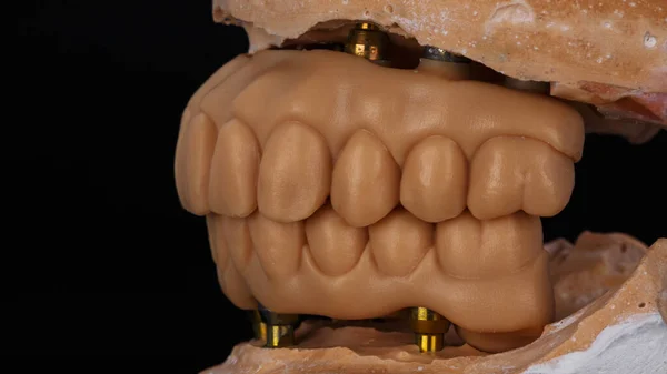 Wax Dental Prostheses Fitting Patient Photo Models Bite Black Background — Stock Photo, Image