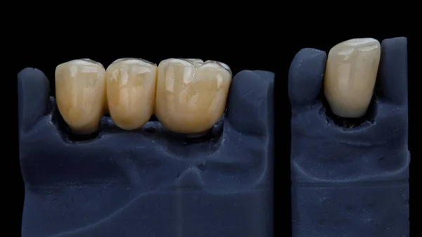 Чотири Зубні Коронки Циркону Моделях — стокове фото