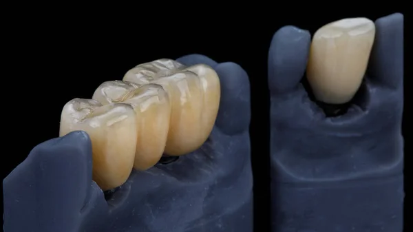 Frezowane Korony Dentystyczne Cyrkonu Modelach Kompozycja Czarnym Tle — Zdjęcie stockowe