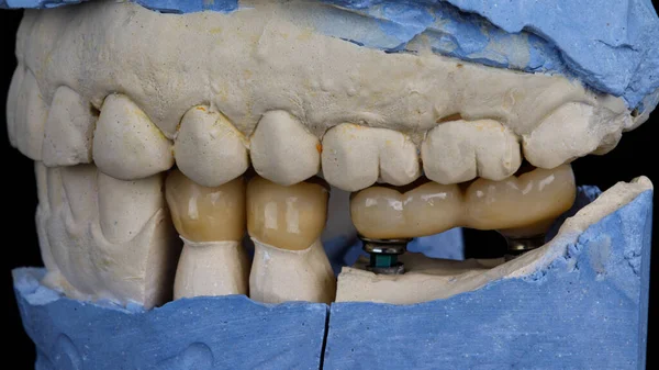 Four Dental Crowns Bite Plaster Models Jaw — Stock Photo, Image