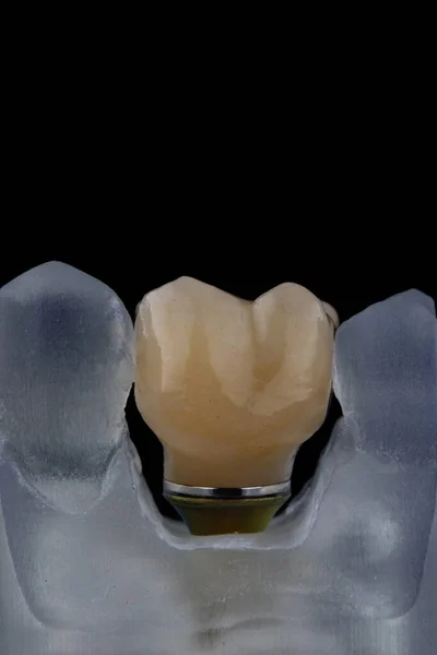 Ceramic Crown Chewing Tooth Model Filmed Black Background — Stock Photo, Image