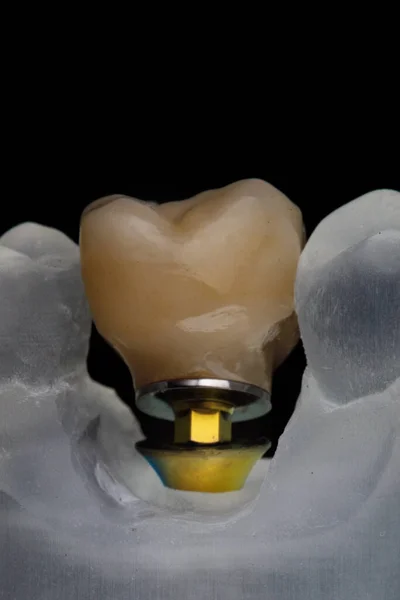Piękna Korona Zęba Żucia Wykonana Cyrkonu Modelem Czarnym Szkle — Zdjęcie stockowe