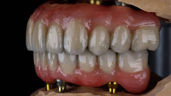 Duas Próteses Dentárias Das Mandíbulas Superior Inferior Mordida Modelos Gesso — Fotografia de Stock