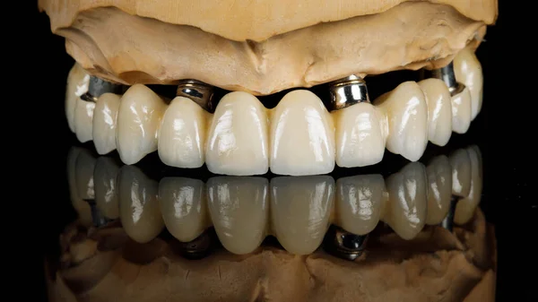 Prótese Dentária Mandíbula Superior Feita Zircônio Vidro Preto Com Reflexão — Fotografia de Stock