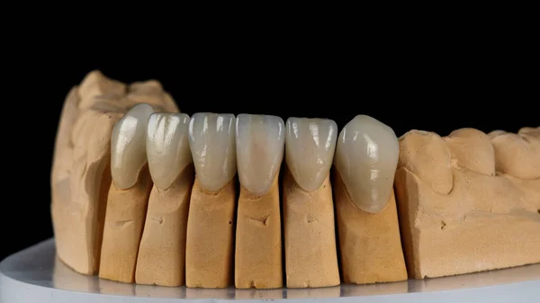 Ceramiczne Okleiny Dentystyczne Naturalnego Koloru Dolnej Szczęki Modelu Zbliżenie Czarnym — Zdjęcie stockowe