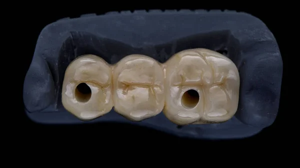 樹脂モデル上の3本の歯のジルコニアデンタルブリッジ 黒い背景の上からの眺め — ストック写真