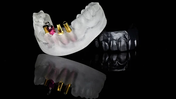 Dental Model Jaw Different Prosthetics Installing Crowns Black Model Jaw — Stock Photo, Image