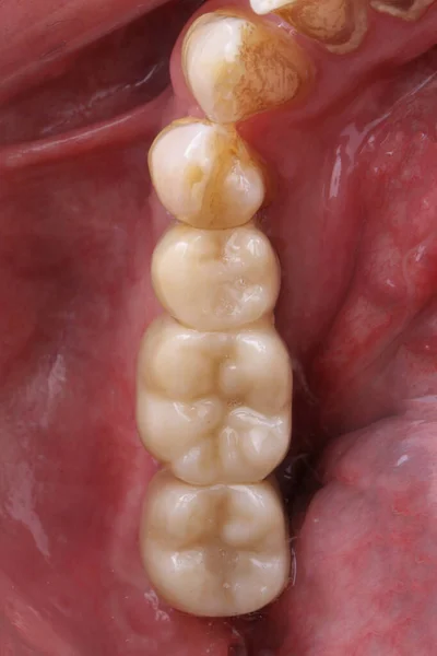 zirconium dental bridge for three chewing teeth installed in the gum cavity with implants