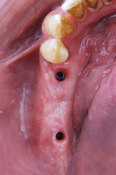 Cavità Gengivale Ricostruita Dopo Impianto Prima Posizionare Ponte Zirconio Ceramica — Foto Stock