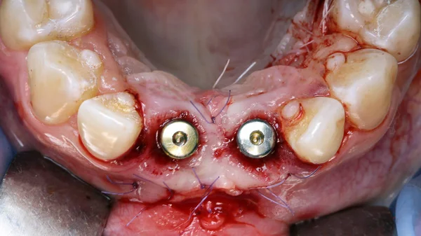 注入後の2つの治癒能力を持つ歯肉炎閉塞の眺め — ストック写真