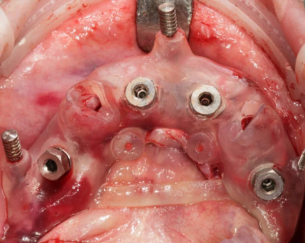 Implantes Dentales Instalados Plantilla Quirúrgica Vista Oclusión Través Del Espejo —  Fotos de Stock