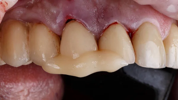 生きた歯の助けを借りて着床後の歯冠の固定と義歯 — ストック写真