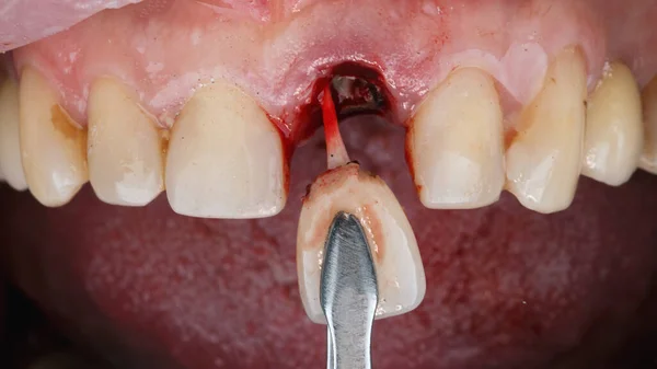 Remoção Dente Central Com Pino Feito Material Carbono Seguido Implantação — Fotografia de Stock