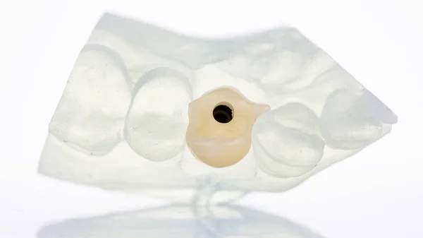 Composición Temporal Corona Dental Sobre Modelo Especial Polímero Sobre Fondo — Foto de Stock