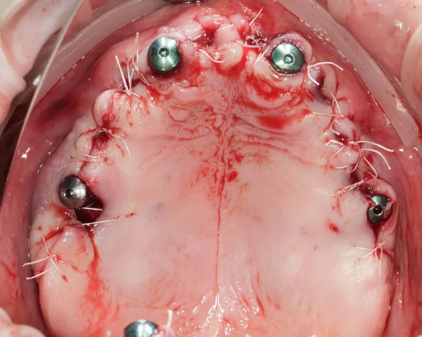 Cavità Della Mucosa Suturata Della Mascella Superiore Dopo Impianto Vista — Foto Stock