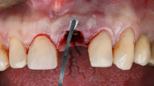 Gengivas Área Dente Central Onde Uma Falta Tecido Para Adição — Fotografia de Stock