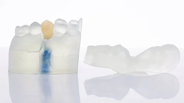Beültetés Céljából Korona Formájában Modellre Sebészeti Mintadarab Fehér Üvegen Visszaverődéssel — Stock Fotó