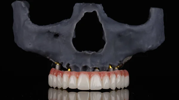 Modelo Dentário Crânio Prótese Mandíbula Superior Sobre Fundo Preto — Fotografia de Stock
