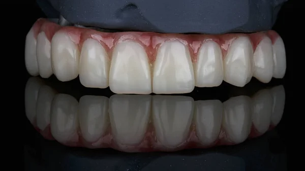 Protesi Dentaria Della Mascella Superiore Modello Speciale Una Stampante — Foto Stock