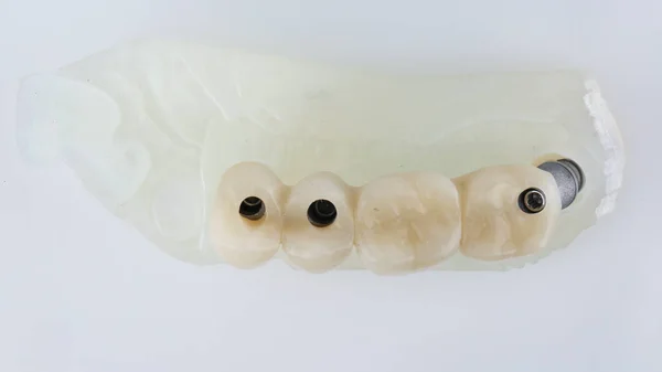 Ponte Dental Para Área Mastigação Modelo Vista Superior Sobre Fundo — Fotografia de Stock