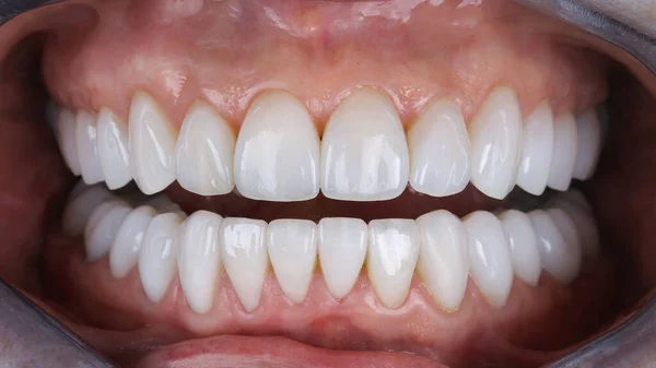 上顎と下顎の静脈で覆われた歯は — ストック写真