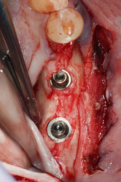 Deux Implants Dentaires Installés Dans — Photo