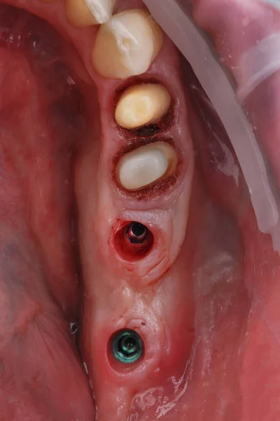人工歯の前に2つのインプラントと準備された歯を持つ歯の空洞の創造的な写真 — ストック写真