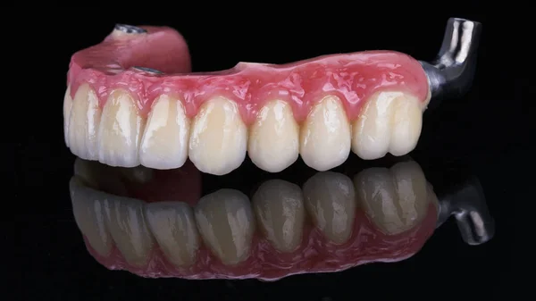 Prótese Dentária Cerâmica Barra Titânio Com Gengiva Artificial Combinada Para — Fotografia de Stock