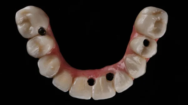 Prótese Dentária Pronta Com Morfologia Vista Superior Sobre Fundo Preto — Fotografia de Stock