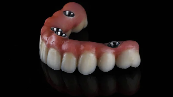 Tandprothese Gemaakt Van Keramiek Een Mooie Roze Gom Zijaanzicht Met — Stockfoto