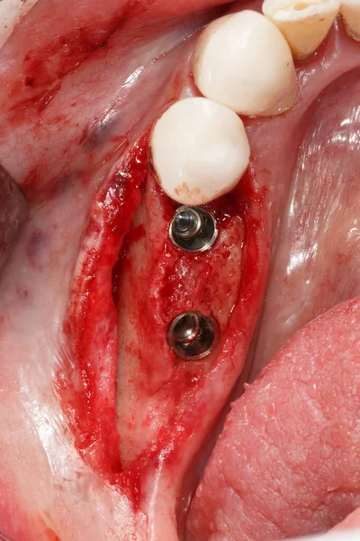 Δύο Εγκατεστημένα Οδοντικά Εμφυτεύματα Στην Οστική Κοιλότητα — Φωτογραφία Αρχείου