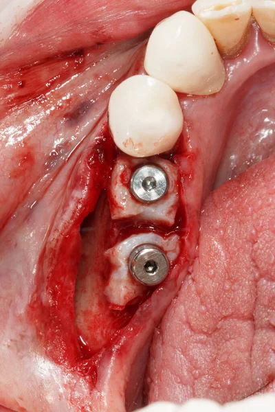 Δύο Εγκατεστημένα Δόντια Εμφυτευμάτων Σχήματα Και Φέτες Μαλακών Ιστών — Φωτογραφία Αρχείου