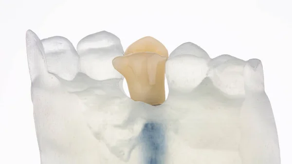 Coroa Dentária Moderna Desgaste Temporário Modelos Impressora Fundo Branco — Fotografia de Stock