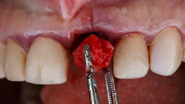 Momento Adição Osso Ktanya Após Implante Dentário Dente Central — Fotografia de Stock
