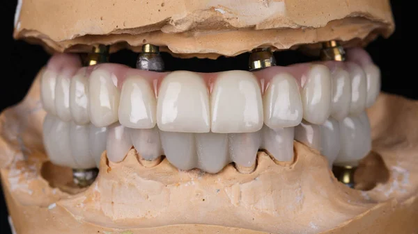 ジルコンからの歯科補綴物と噛んだ時のモデル上の橋 — ストック写真