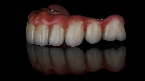 Metal Cerâmica Dentária Prótese Maxilar Superior Vidro Preto Com Reflexo — Fotografia de Stock