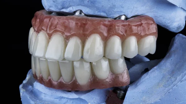 青い石膏モデルの上顎と下顎の入れ歯 — ストック写真