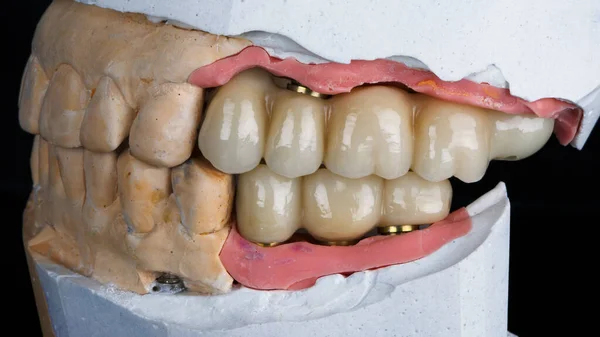 石膏模型による大きなセラミック製の義歯ではなく — ストック写真