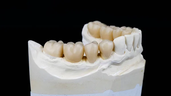 Coroas Zircão Dental Para Mandíbula Inferior Modelo Gesso Filmado Fundo — Fotografia de Stock