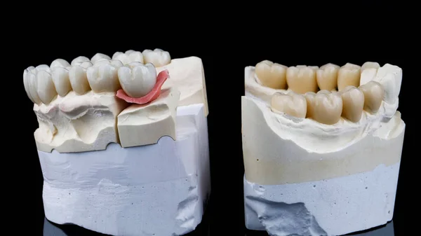 黒の背景の石膏製の歯科モデルのセラミックとジルコンの冠のセット — ストック写真