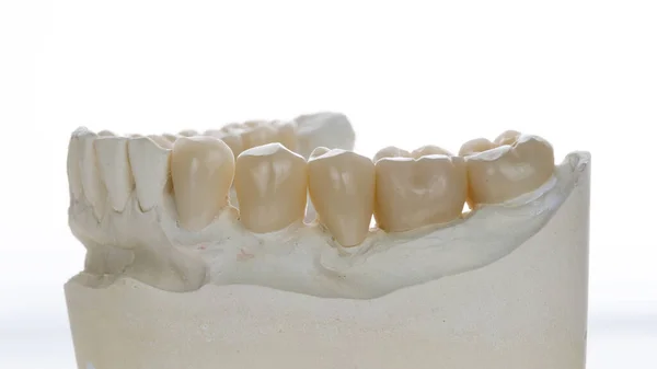 Excelentes Coroas Zircônio Modelo Dental Filmado Fundo Branco Brilhante — Fotografia de Stock