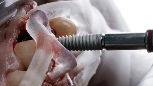 Taraftaki Bir Cerrahi Şablon Vasıtasıyla Yerleştirme Sırasında Diş Implantı — Stok fotoğraf