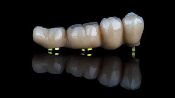 Dental Bridge Made Zircon Fixation Three Implants Chewing Part Shot — Stock Photo, Image