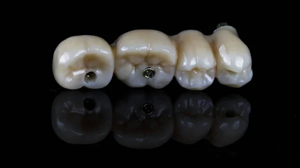 Mostek Cyrkonowy Mocowania Trzech Implantach Części Żucia Morfologia Zębów Pokazano — Zdjęcie stockowe