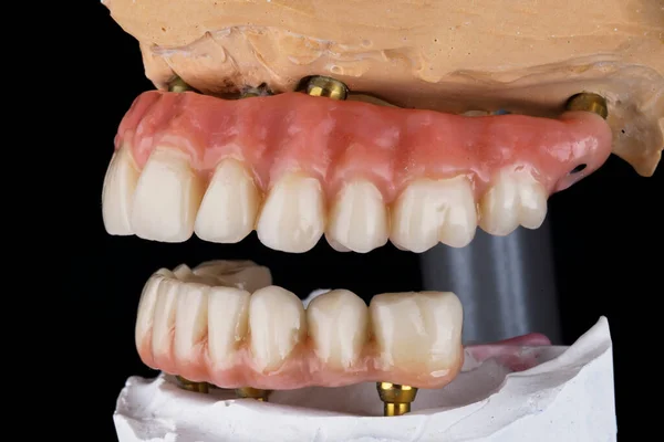 ピンクのガムで上顎と下顎の入れ歯 — ストック写真