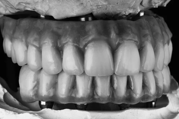 Prótesis Dentales Naturales Alta Calidad Con Goma Rosa Circonio Cerámica —  Fotos de Stock