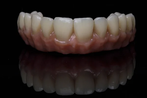 Prótese Dentária Feita Zircão Cerâmica Mandíbula Superior Com Uma Gengiva — Fotografia de Stock
