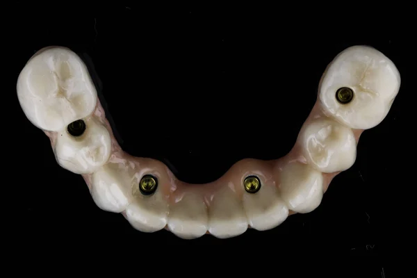 Prótese Mandíbula Superior Dental Com Goma Rosa Vidro Preto Vista — Fotografia de Stock